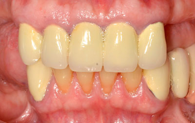 Отсутствие зубов в жевательной зоне