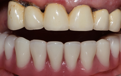 восстановление всего зубного ряда по технологии All-on-6