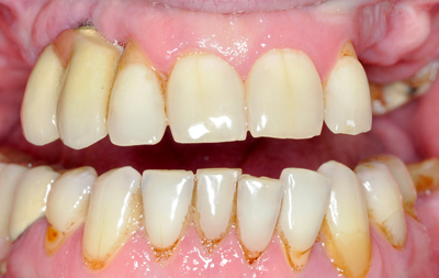 Отсутствие жевательных зубов