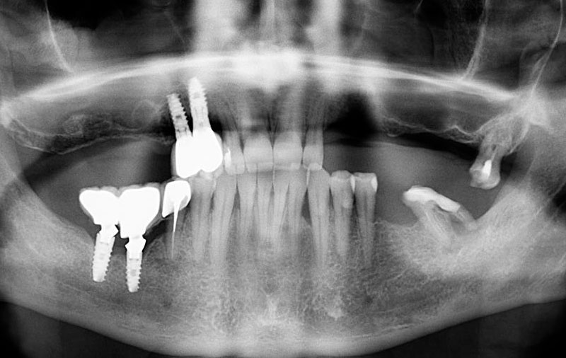 Снимок Отсутствие жевательных зубов