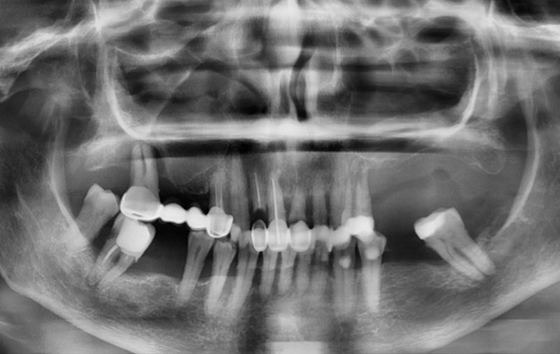 Снимок Фото до скуловой имплантации зубов
