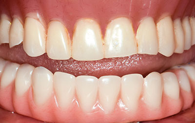 Фото после проведения имплантации зубов
