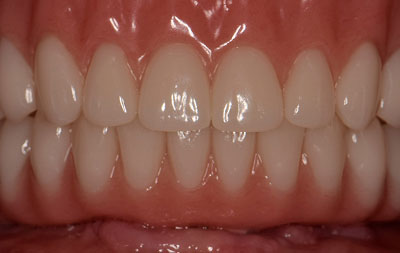 Фото после перепротезирования зубов на имплантах