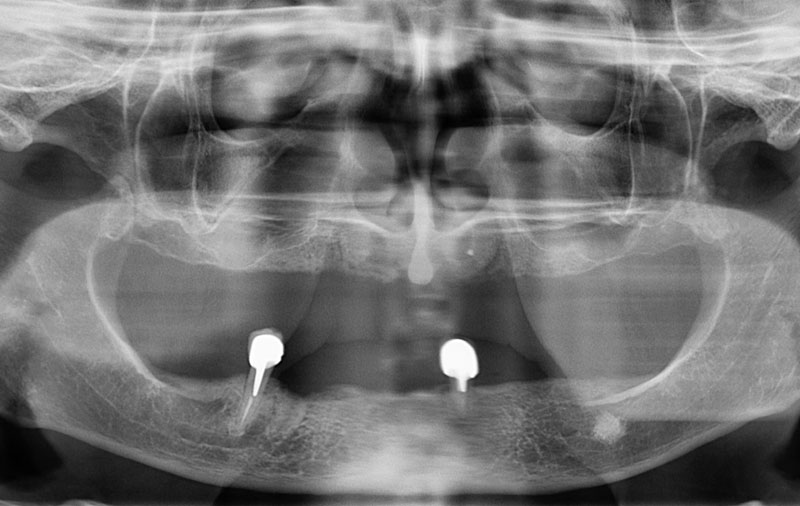 Снимок Фото состояния зубов до комплексной имплантации зубов