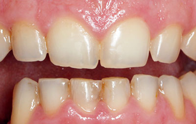 зубы после снятия брекетов
