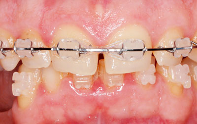 на фото зубы в процессе лечения брекетами