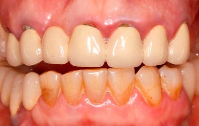 Отсутствие зубов и пародонтит