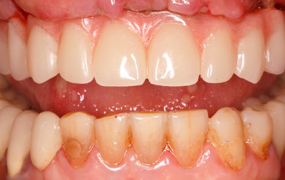 Скуловая имплантация для восстановления зубов на верхней челюсти