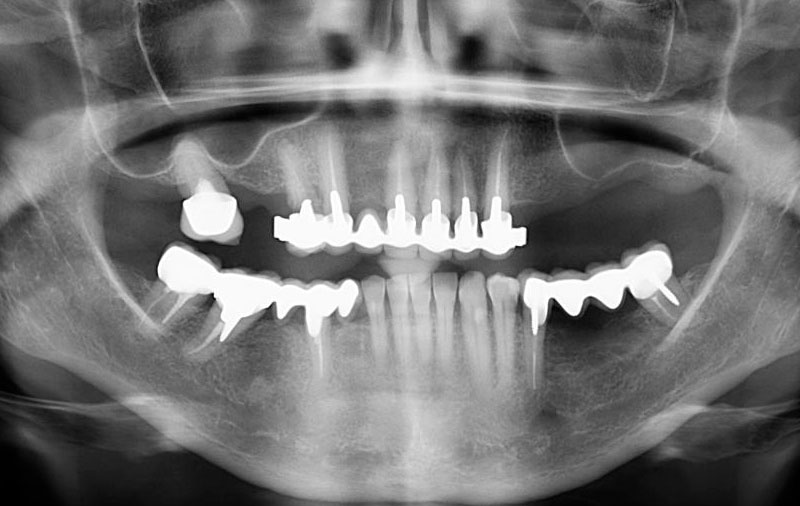 Снимок Отсутствие зубов и пародонтит