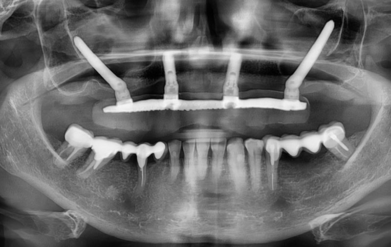 Снимок Скуловая имплантация для восстановления зубов на верхней челюсти