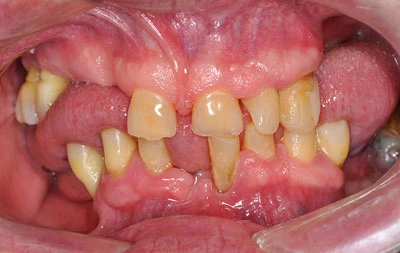 Фото состояния зубов с пародонтитом и пародонтозом