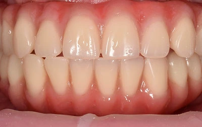 Фото после восстановления зубов комплексом имплантов