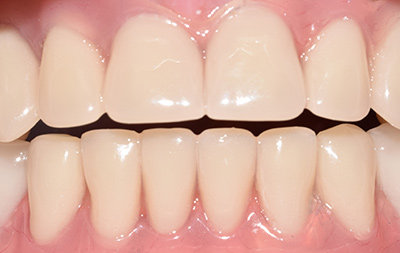 имплантация зубов с использованием односоставных имплантов