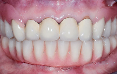 Фото зубов после имплантации all-on-4