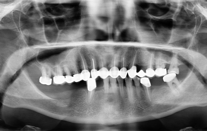 Снимок Фото зубов до имплантации