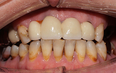 Отсутствие части зубов