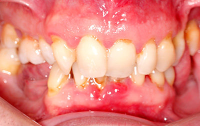 Частичное отсутствие зубов