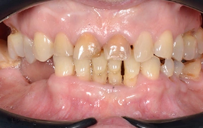Фото зубов пациентки до установки зубных имплантов