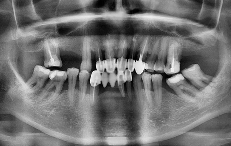 Снимок Фото до проведения имплантации всех зубов за 3 дня