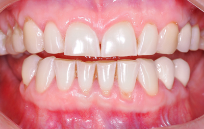 Отсутствие зубов в жевательной зоне на нижней челюсти