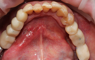 Зубы восстановлены с помощью одноэтапной имплантации