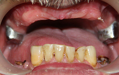 Отсутствие почти всех зубов на верхней челюсти