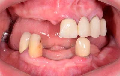 Фото с почти полностью отсутствующими зубами в полости рта