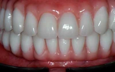 Фото зубов после комплексмной имплантации Straumann Pro Arch