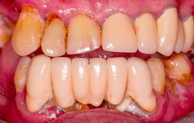 Острый генерализованный пародонтит, частичное отсутствие и подвижность зубов