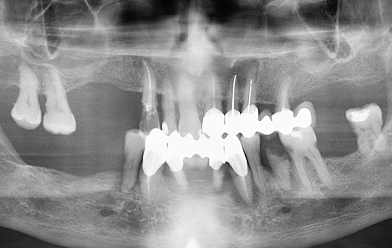 Снимок Острый генерализованный пародонтит, частичное отсутствие и подвижность зубов