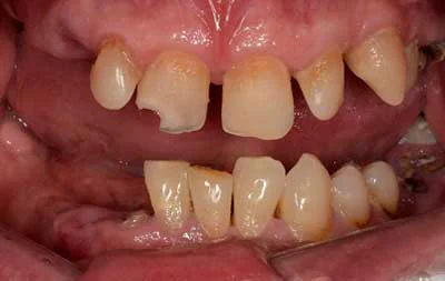 Фото состояния зубов до проведенной имплантации зубов за 1 день