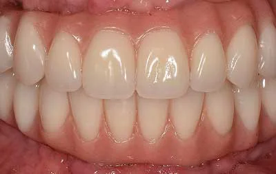 Фото состояния зубов после проведенной имплантации зубов за 1 день