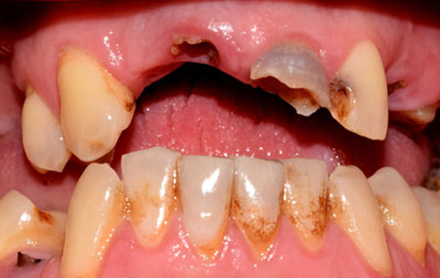 Множественное разрушение зубов после ДТП
