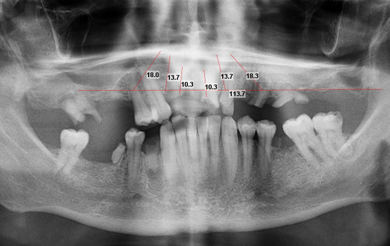 Снимок Множественное разрушение зубов после ДТП