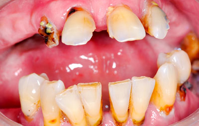 До имплантации зубов при пародотите
