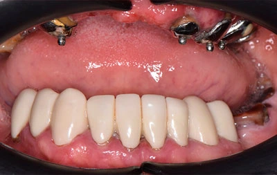 Фото до проведения комплексной имплантации зубов