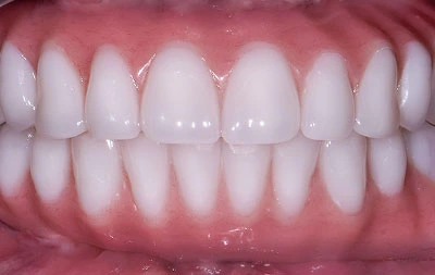 Фото после комлексной имплантации зубов