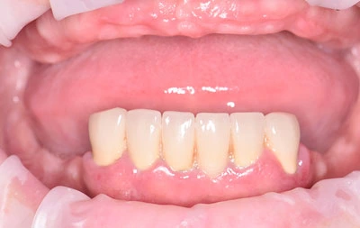 Фото с полностью отсутствующими зубами на верхней челюсти