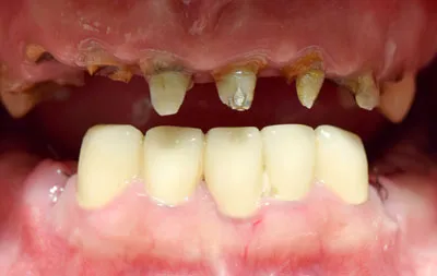 Практически полное отсутствие зубов на верхней челюсти