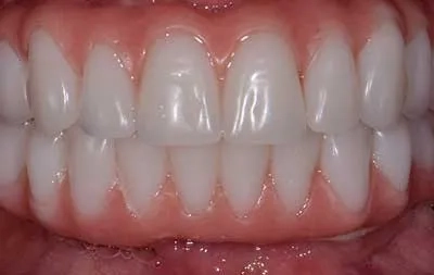 Фото после проведенной имплантации зубов на верхней и нижней челюстях