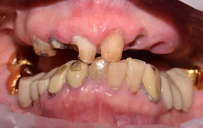 Фото зубов пациентки до комплексной имплантации зубов