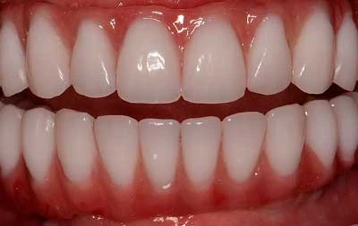 Фото результата лечения и установки комплекса зубных имплантов