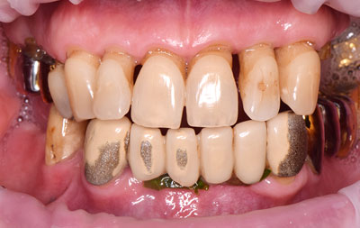 Фото зубов до установки комплекса зубных имплантов