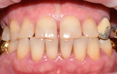 Частичное отсутствие зубов жевательной группы