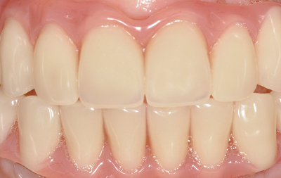 Восстановление всех зубов на верхней и нижней челюстях