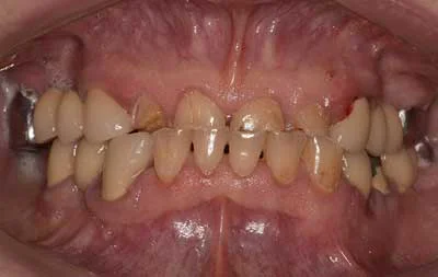 Состояние зубов: проблемы с деснами и стираемость зубов