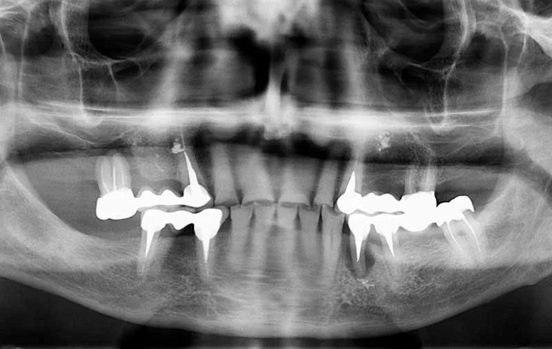 Снимок Состояние зубов: проблемы с деснами и стираемость зубов
