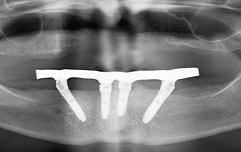 Снимок Восстановление всех зубов на нижней челюсти