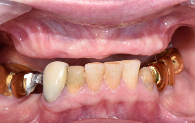 Ситуация с зубами до имплантации