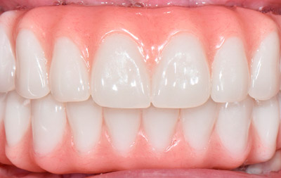 После имплантации зубов all-on-4